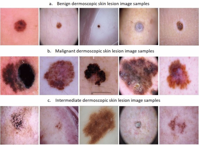 Dermoscopy Classification Example