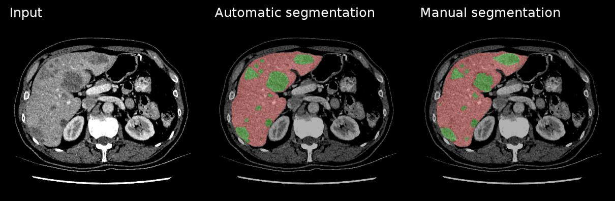 Tumor Delineation