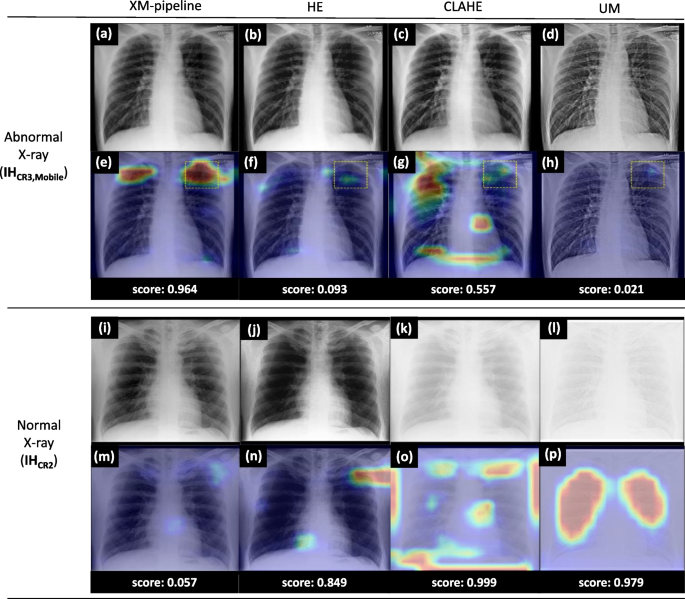 Chest X-ray with Nodule Highlighted